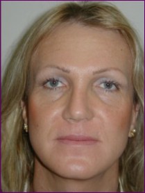 After facial feminisation